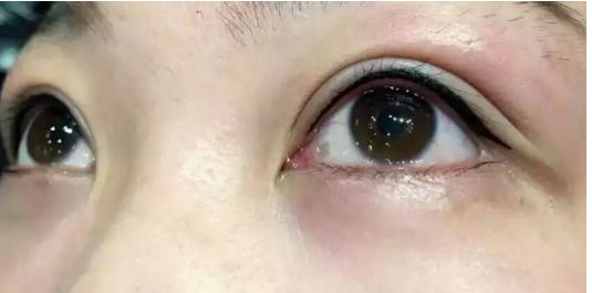 全面評(píng)估2023年全國雙眼皮手術(shù)醫(yī)生實(shí)力大揭秘