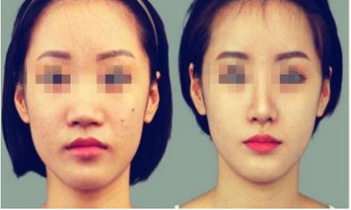 贛州哪家醫(yī)院的鼻部整形好？