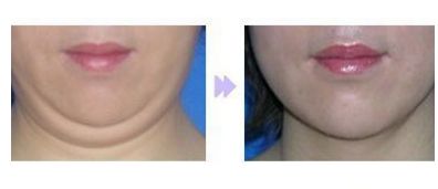 成都友誼醫(yī)院整形科優(yōu)秀醫(yī)師推薦：全臉脂肪填充效果如何？