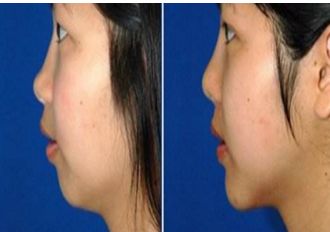 長(zhǎng)春銘醫(yī)整形注射哪位醫(yī)師技術(shù)精湛？專家推薦與費(fèi)用一覽