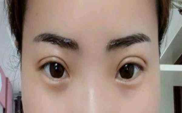 丁硯江填充脂肪的效果如何？為什么該方法備受推崇？