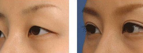 上海九院凸嘴手術(shù)費用高昂？手術(shù)技術(shù)如何？推薦醫(yī)生參考