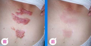 九院脂肪填充，醫(yī)生技術(shù)高超，詳細(xì)價(jià)格表揭曉