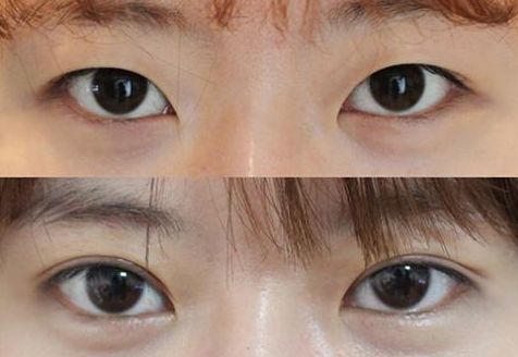 廣州曙光整形醫(yī)院的鼻部整形效果如何？收費(fèi)如何？真實(shí)案例分享！