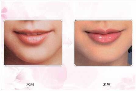 鄭州禾麗整形2023年吸脂案例分享