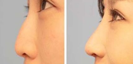 長春最可信賴的自體脂肪豐胸醫(yī)院，專業(yè)可靠的推薦