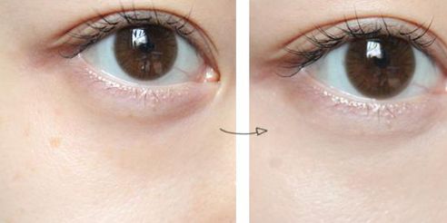 德陽王亞國雙眼皮修復(fù)90天體驗細節(jié)圖分享