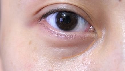 【重慶】銅雀臺雙眼皮醫(yī)生技術(shù)對比，伍森林、王杰醫(yī)、梁海彬誰更厲害？