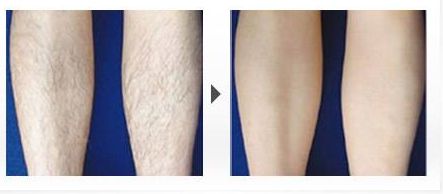 脂肪豐額頭手術(shù)的效果如何？了解專家的分享