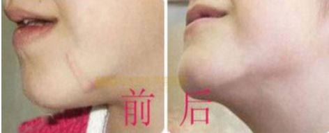 長沙最佳吸脂手術(shù)醫(yī)院排名，雅美、華韓華美、鵬愛等值得借鑒的評價