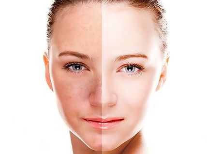 深圳米蘭柏羽整形醫(yī)院王志東醫(yī)生雙眼皮價(jià)格及成功案例分享