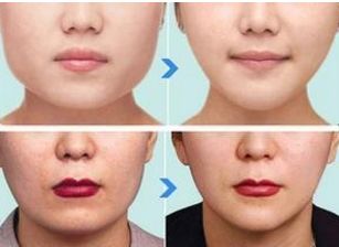 福建地區(qū)五家領(lǐng)先拉皮整形醫(yī)院盤點(diǎn)！專業(yè)技術(shù)、良好口碑！