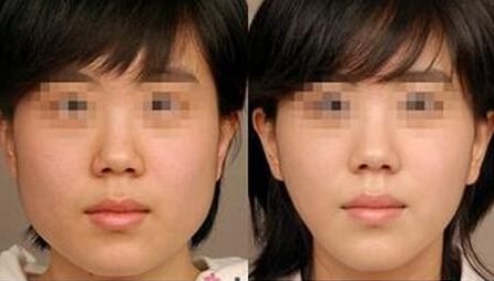 昆明自體脂肪填充專業(yè)醫(yī)院排行榜！獲取數(shù)量前十的醫(yī)療機構名單！