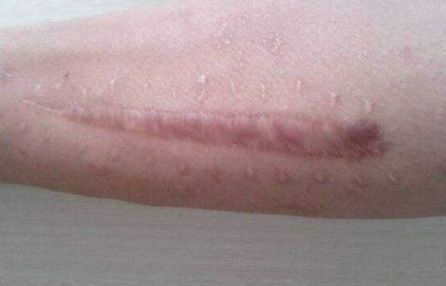 北京藝星白書白師傅，2023獨(dú)家案例揭秘：雙眼皮手術(shù)讓你閃耀美麗！