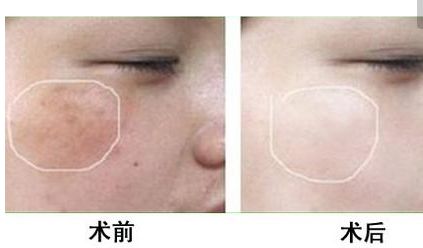 長沙美田芳斌雙眼皮讓你驚艷！令人難忘的改變來襲！