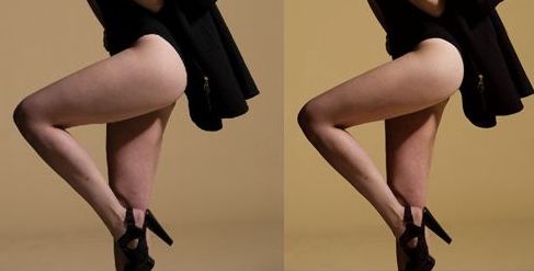 蘭州亞韓整形醫(yī)院的雙眼皮手術效果如何？親身體驗分享+手術案例解析