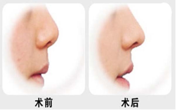 燕雄鼻子整容結(jié)果亮相！專家實(shí)力和成功案例揭秘