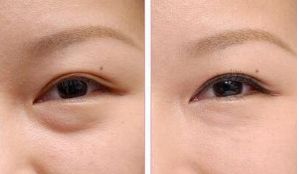 李鴻軍醫(yī)生點評：上?；颊叩谋亲诱谓?jīng)驗分享