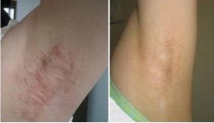 南京哪家醫(yī)院能夠完美實(shí)現(xiàn)雙眼皮手術(shù)的期望？