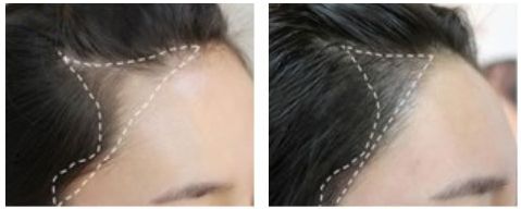 西安丁合軍的鼻子修復效果如何？90天真實案例分享