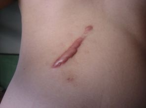 滄州靜港醫(yī)院雙眼皮手術(shù)效果如何？哪位醫(yī)生值得信賴？手術(shù)費用參考表同步分享