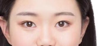 山東省立醫(yī)院整形外科激光祛斑真的有效嗎？