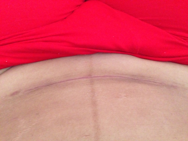 如何避免自體脂肪注射豐胸的風(fēng)險(xiǎn)？務(wù)必掌握這些關(guān)鍵信息