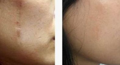 國內(nèi)有哪些值得推薦的磨骨權(quán)威專家？優(yōu)秀磨骨師張笑天、李志海等值得關(guān)注