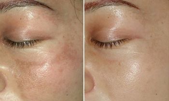 李天石做眼皮手術(shù)費(fèi)用昂貴？個(gè)人體驗(yàn)分享：三個(gè)月改變！