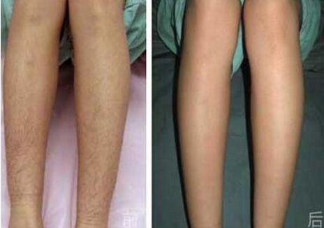 溫州自體脂肪隆鼻哪家醫(yī)院靠譜？熱門醫(yī)院推薦排行榜揭曉！