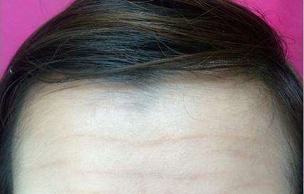 陳金超醫(yī)生高效雙眼皮效果秀！超卓案例展示揭示驚喜效果！