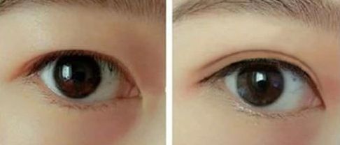 王永功鼻部整形：醫(yī)生簡介及隆鼻前后對比照展示