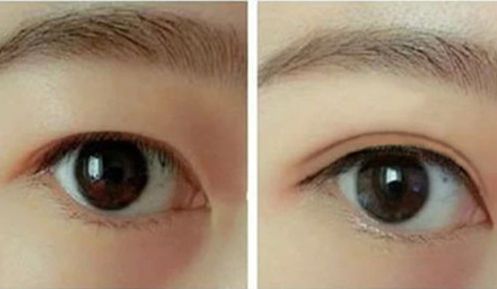 李世榮隆鼻的效果如何？西南醫(yī)院醫(yī)生經(jīng)典案例揭秘