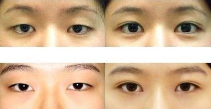 西安眼袋專家醫(yī)生整理盤推薦！排名前五強(qiáng)備受好評(píng)！實(shí)力驚艷！