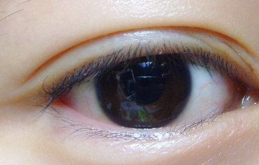 健麗整形醫(yī)院的去眼袋效果如何？2023患者分享案例！