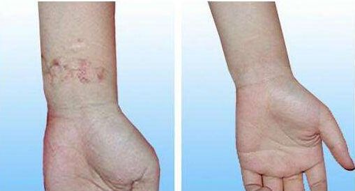 柴云醫(yī)生做雙眼皮后亮麗綻放！欣賞真實案例，驚艷非凡的視覺效果！