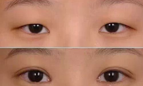 令人驚嘆！揭秘武漢華亞吳欣醫(yī)生的雙眼皮手術(shù)，身份資料披露！