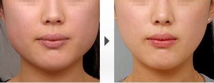 國內(nèi)治療兔唇的整形醫(yī)院排名大揭秘！這幾家醫(yī)院都在榜上