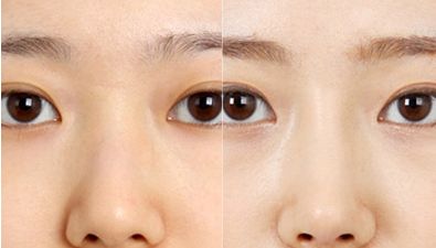 專業(yè)排行榜出爐！北京最頂級雙眼皮醫(yī)生名單公布！