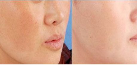 朱海男全切雙眼皮手術(shù)費(fèi)用及醫(yī)生簡(jiǎn)介、價(jià)格表解析！