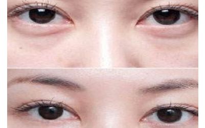 北京張笑天的下頜角手術技術及豐碩成果曝光！醫(yī)術精湛，案例展示震撼人心