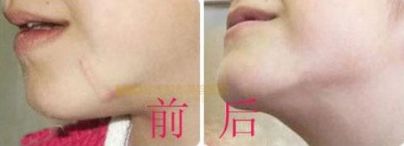 上海哪家醫(yī)院有專業(yè)的唇裂手術(shù)醫(yī)生？治療兔唇患者的必備信息！