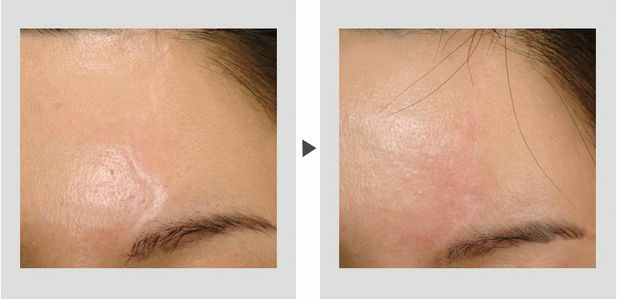 北京八大處哪個(gè)整形醫(yī)院的雙眼皮手術(shù)效果好？推薦醫(yī)生和價(jià)格！