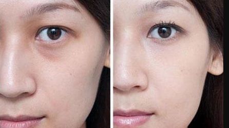 肉毒素除皺：您應(yīng)該意識到這些潛在風(fēng)險