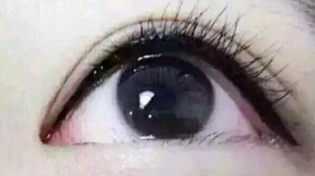 深圳哪家醫(yī)院割雙眼皮效果更好？值得推薦！