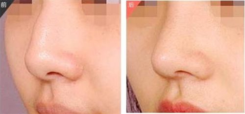 高級鼻部矯正解決方案：2023年全國頂尖修復(fù)醫(yī)師榜單揭曉