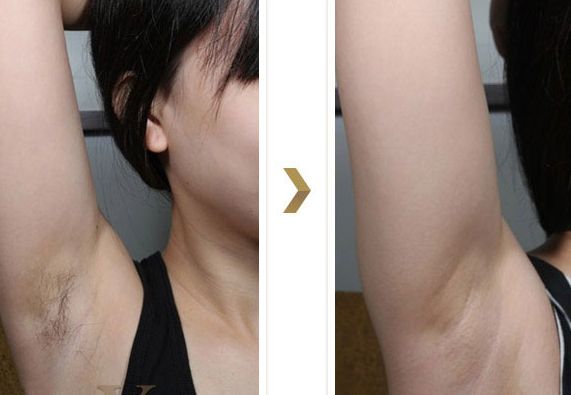 長沙湘雅醫(yī)院的減肥科如何？大腿吸脂效果如何？