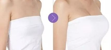 成都華美邱偉醫(yī)師分享隆鼻案例，鼻部塑造效果驚艷！