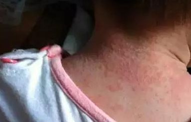 黃開亮眼睛美不美，醫(yī)生經驗公開！看雙眼皮整形成功案例