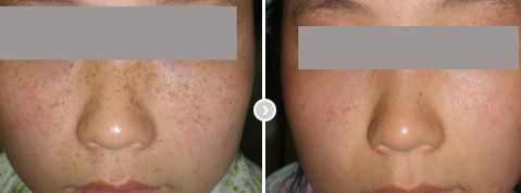 重慶張恒術(shù)雙眼皮：附一院醫(yī)生的精湛技藝贏得贊譽(yù)